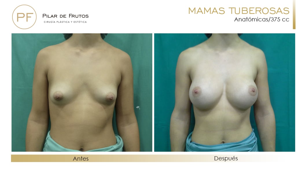 Mamas Tuberosas Antes y Después Mamas Tuberosas Antes y Después
