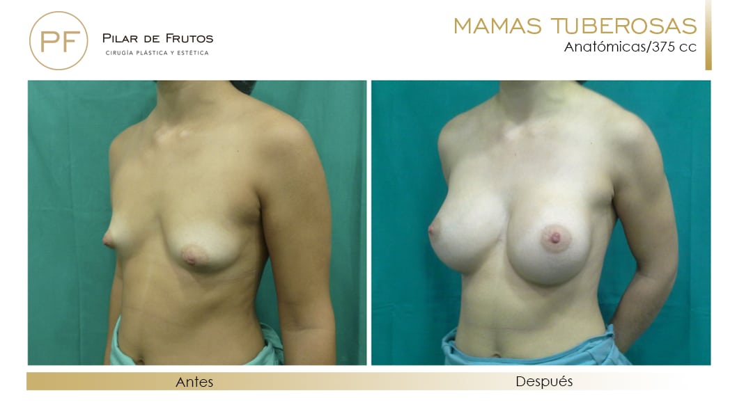Mamas Tuberosas Antes y Después Mamas Tuberosas Antes y Después