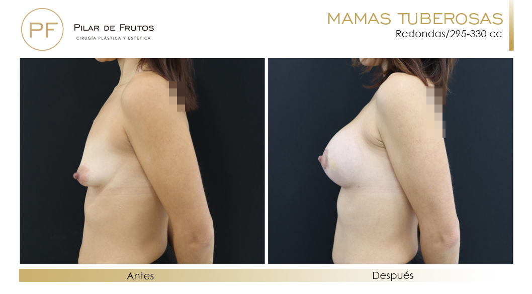 Mamas Tuberosas Antes y Después Mamas Tuberosas Antes y Después