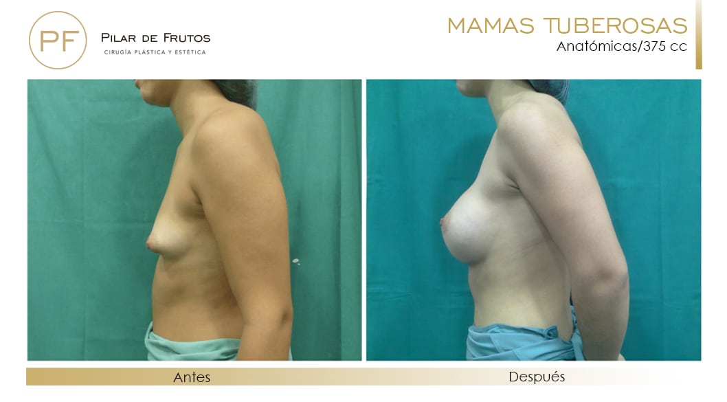 Mamas Tuberosas Antes y Después Mamas Tuberosas Antes y Después