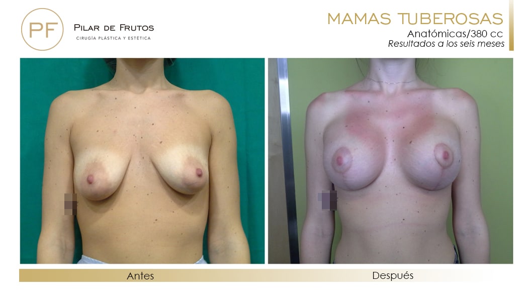 Mamas Tuberosas Antes y Después Mamas Tuberosas Antes y Después