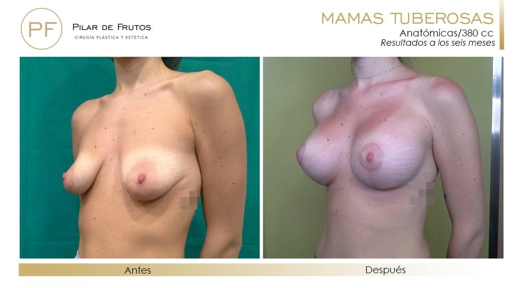 Mamas Tuberosas Antes y Después Mamas Tuberosas Antes y Después
