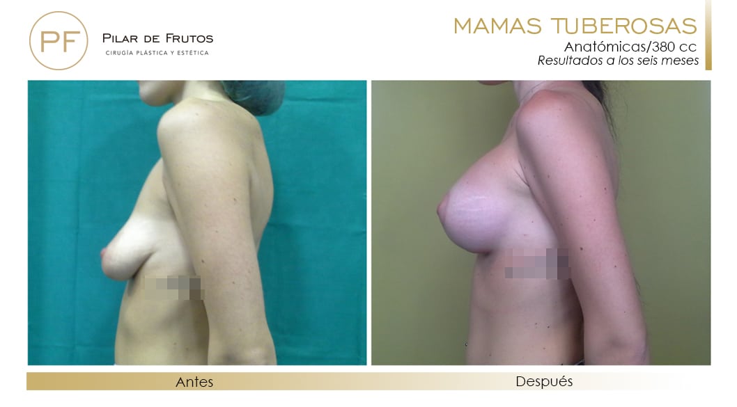 Mamas Tuberosas Antes y Después Mamas Tuberosas Antes y Después