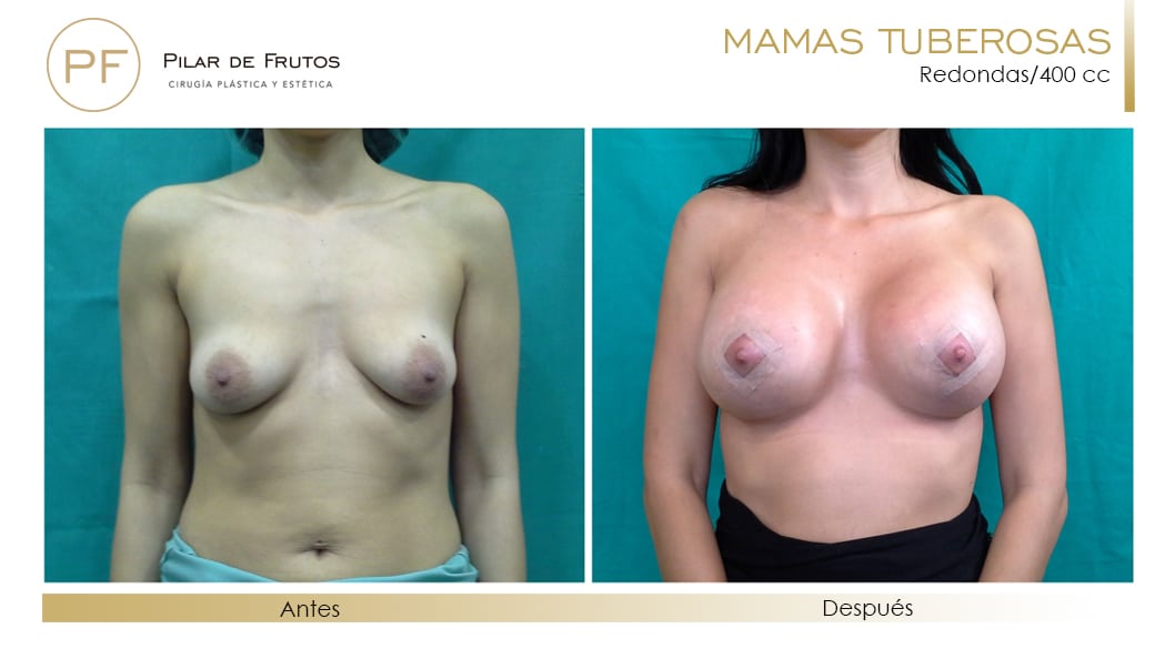 Mamas Tuberosas Antes y Después Mamas Tuberosas Antes y Después