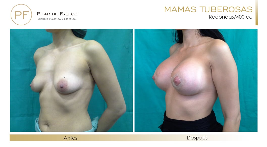 Mamas Tuberosas Antes y Después Mamas Tuberosas Antes y Después