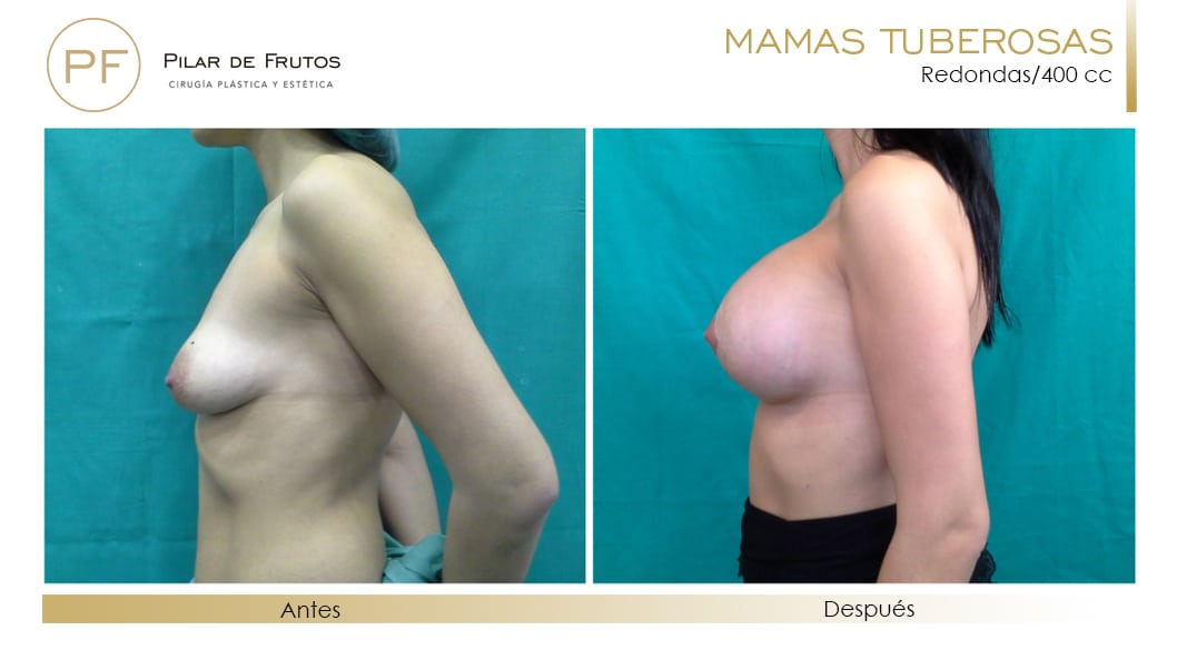 Mamas Tuberosas Antes y Después Mamas Tuberosas Antes y Después