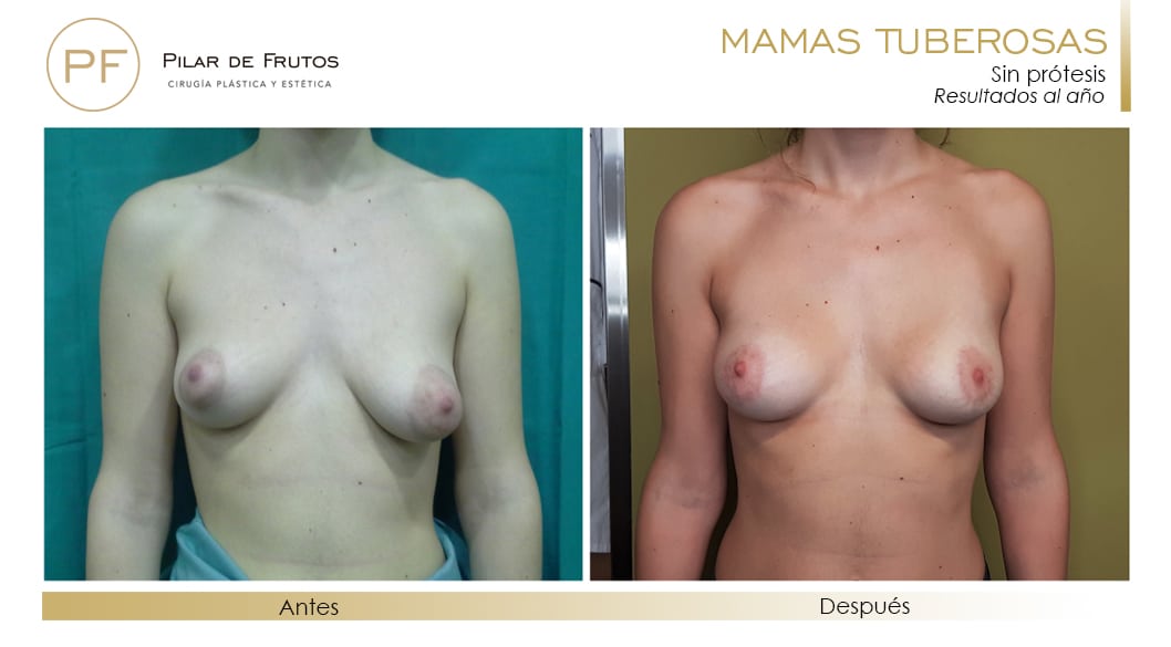 Mamas Tuberosas Antes y Después Mamas Tuberosas Antes y Después