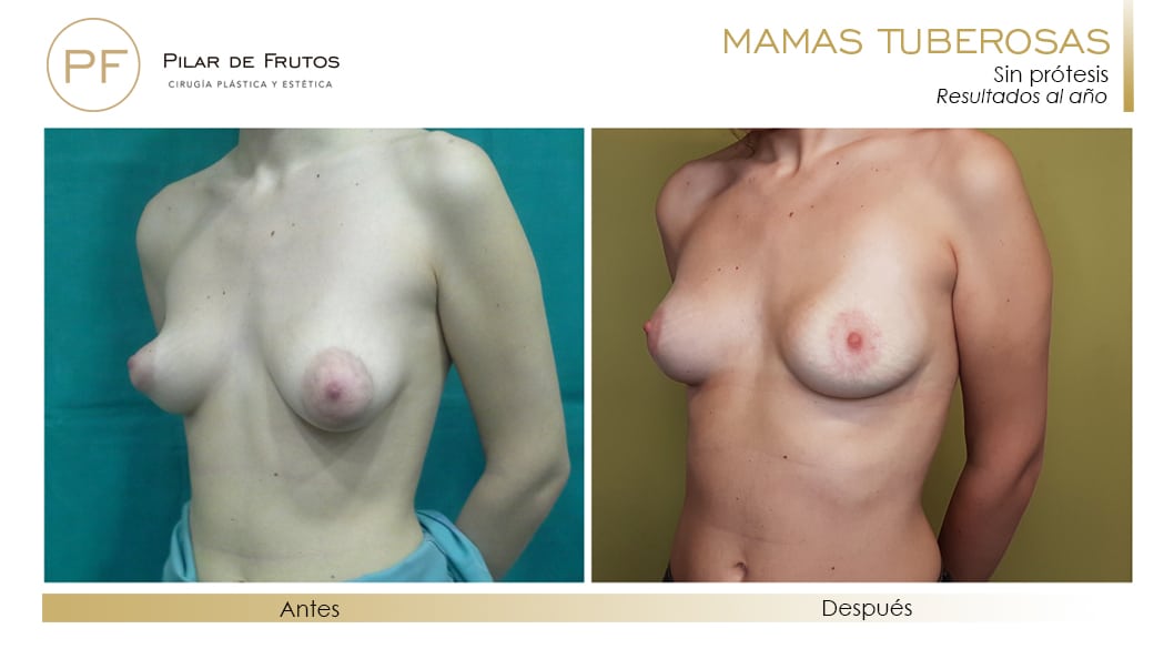 Mamas Tuberosas Antes y Después Mamas Tuberosas Antes y Después