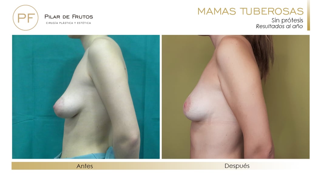 Mamas Tuberosas Antes y Después Mamas Tuberosas Antes y Después