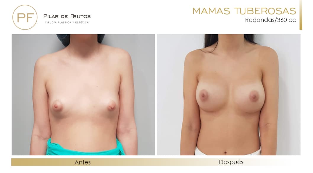 Mamas Tuberosas Antes y Después Mamas Tuberosas Antes y Después