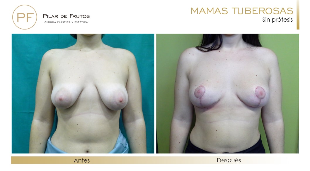 Mamas Tuberosas Antes y Después Mamas Tuberosas Antes y Después