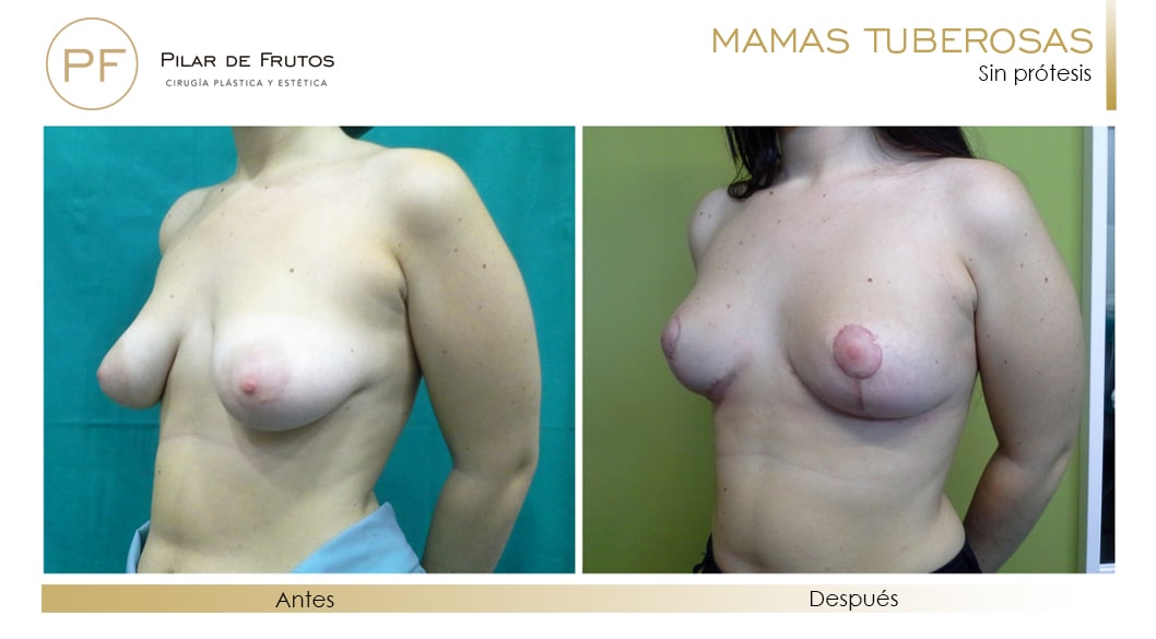 Mamas Tuberosas Antes y Después Mamas Tuberosas Antes y Después