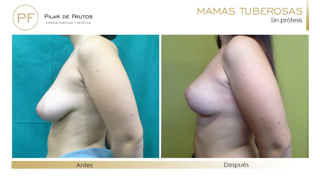 Mamas Tuberosas Antes y Después Mamas Tuberosas Antes y Después