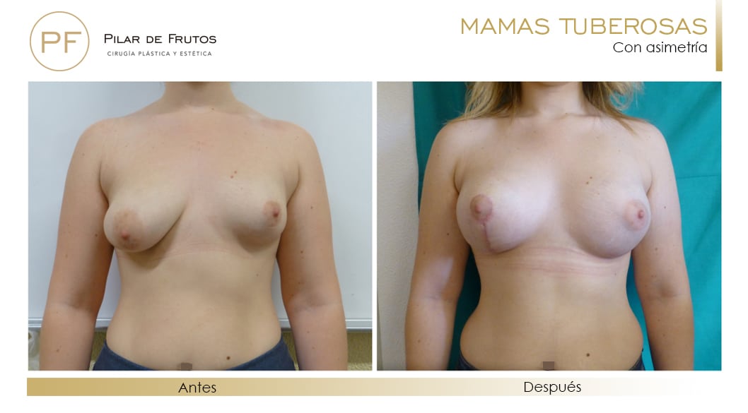 Mamas Tuberosas Antes y Después Mamas Tuberosas Antes y Después