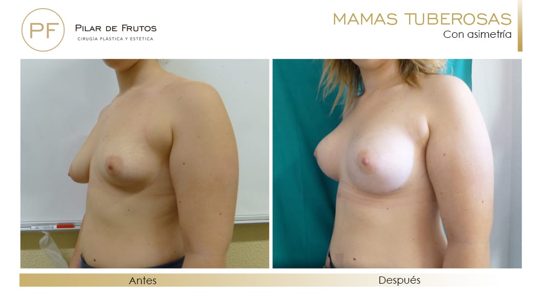 Mamas Tuberosas Antes y Después Mamas Tuberosas Antes y Después