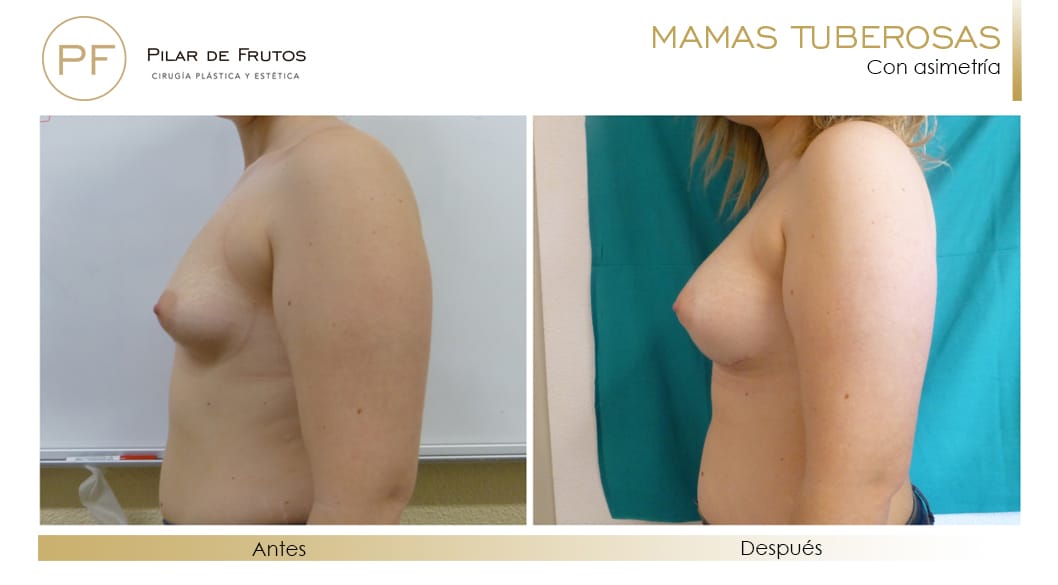 Mamas Tuberosas Antes y Después Mamas Tuberosas Antes y Después