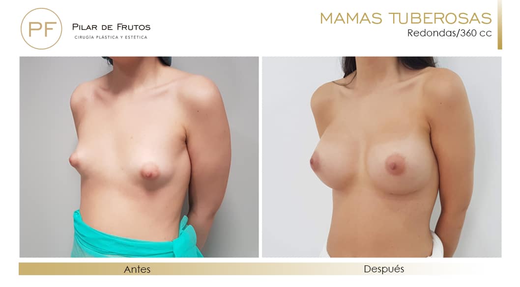 Mamas Tuberosas Antes y Después Mamas Tuberosas Antes y Después
