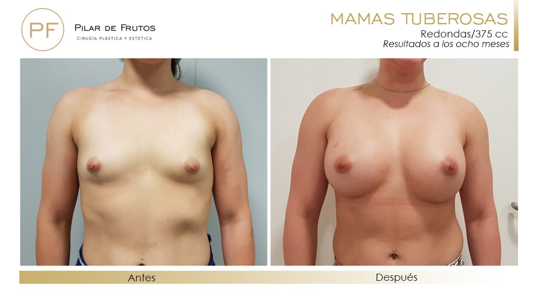 Mamas Tuberosas Antes y Después Mamas Tuberosas Antes y Después