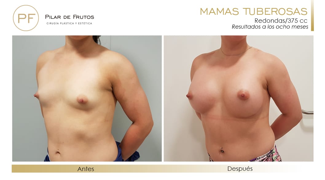 Mamas Tuberosas Antes y Después Mamas Tuberosas Antes y Después