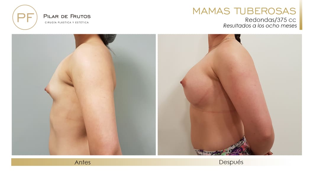 Mamas Tuberosas Antes y Después Mamas Tuberosas Antes y Después