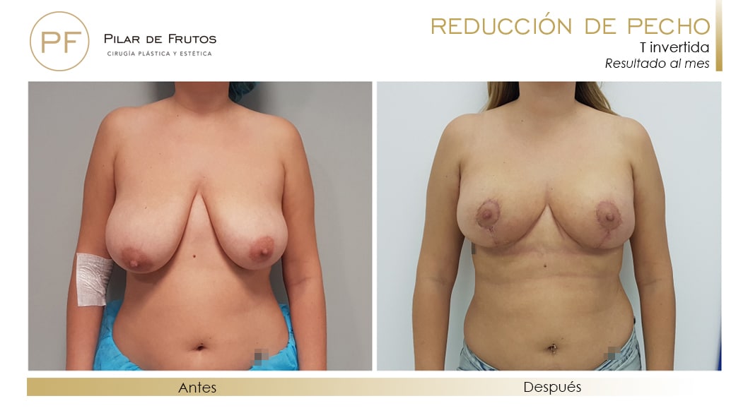 Reducción de pecho Antes y Después