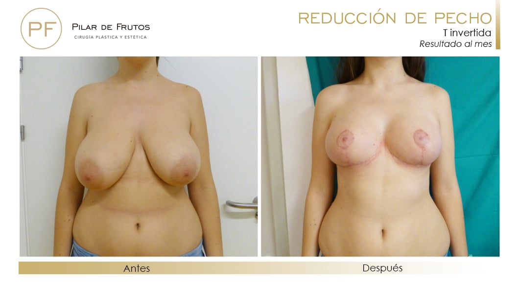 Reducción de pecho Antes y Después