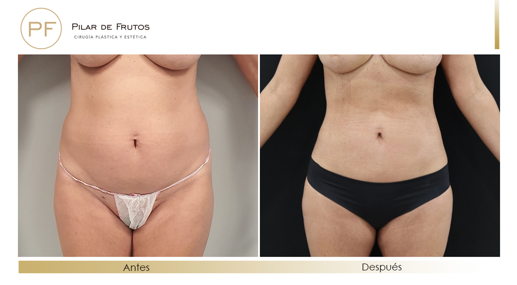 Fotos de eliminar la flacidez con Renuvion J-Plasma antes y despues