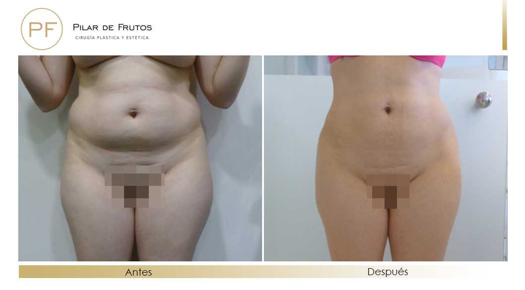 Body Tite Liposucción sin cirugía antes y después Body Tite Liposucción sin cirugía antes y después