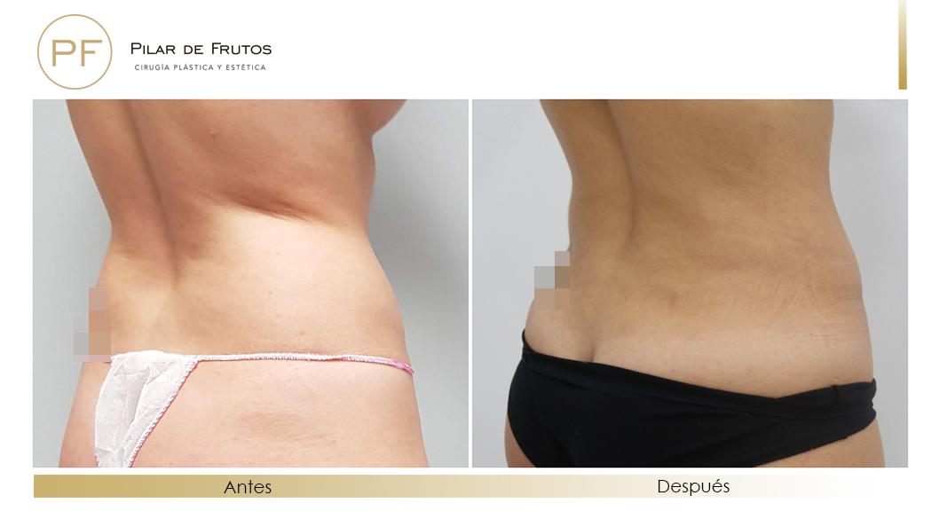 Body Tite Liposucción sin cirugía antes y después Body Tite Liposucción sin cirugía antes y después