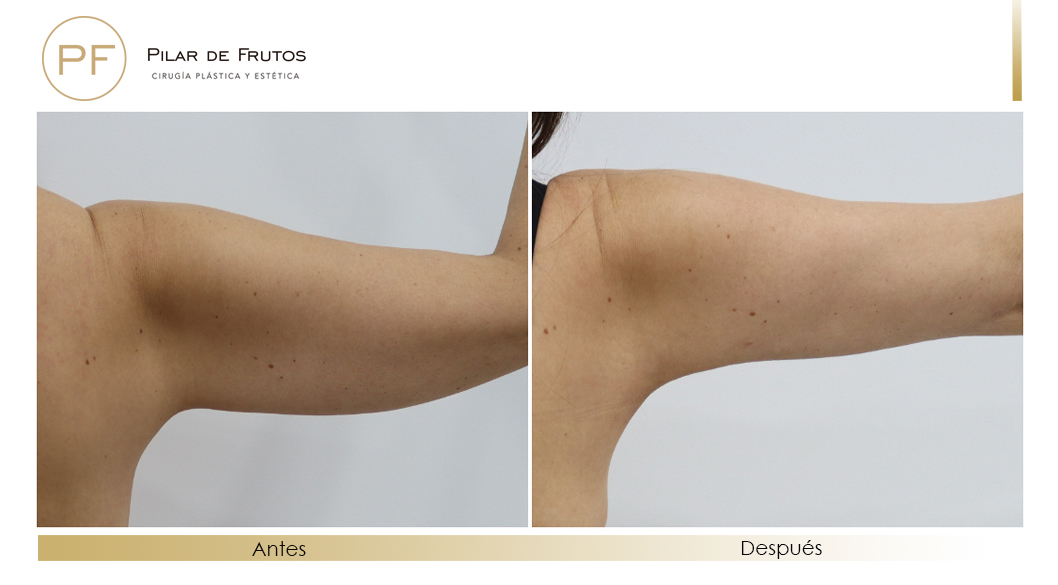 Body Tite Liposucción sin cirugía antes y después Body Tite Liposucción sin cirugía antes y después