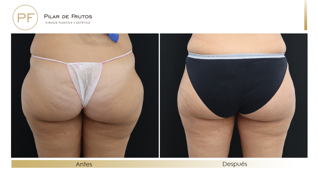 Body Tite Liposucción sin cirugía antes y después Body Tite Liposucción sin cirugía antes y después
