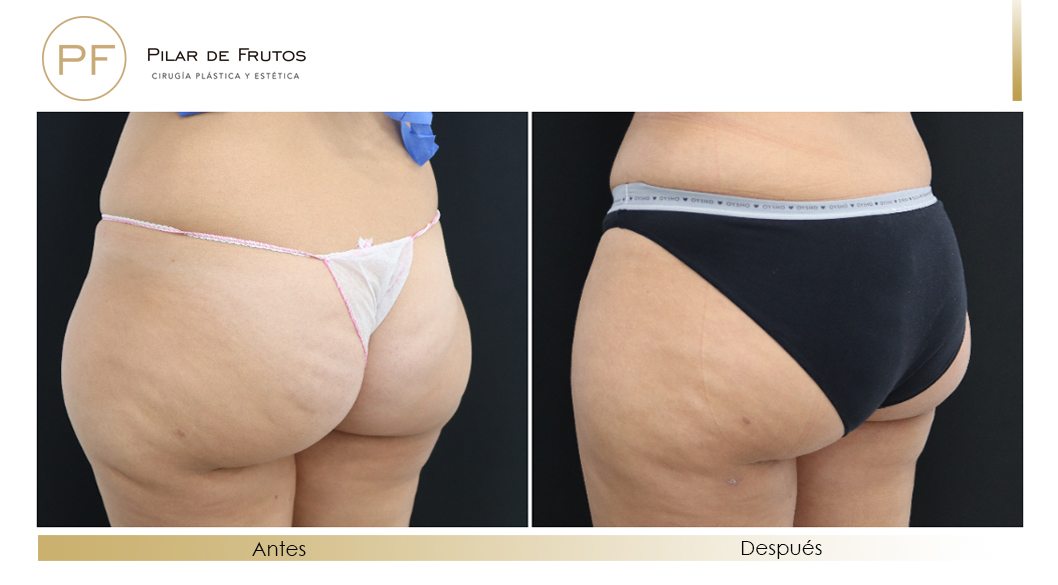 Body Tite Liposucción sin cirugía antes y después Body Tite Liposucción sin cirugía antes y después