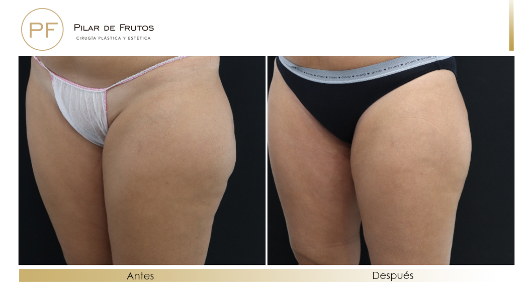 Body Tite Liposucción sin cirugía antes y después Body Tite Liposucción sin cirugía antes y después