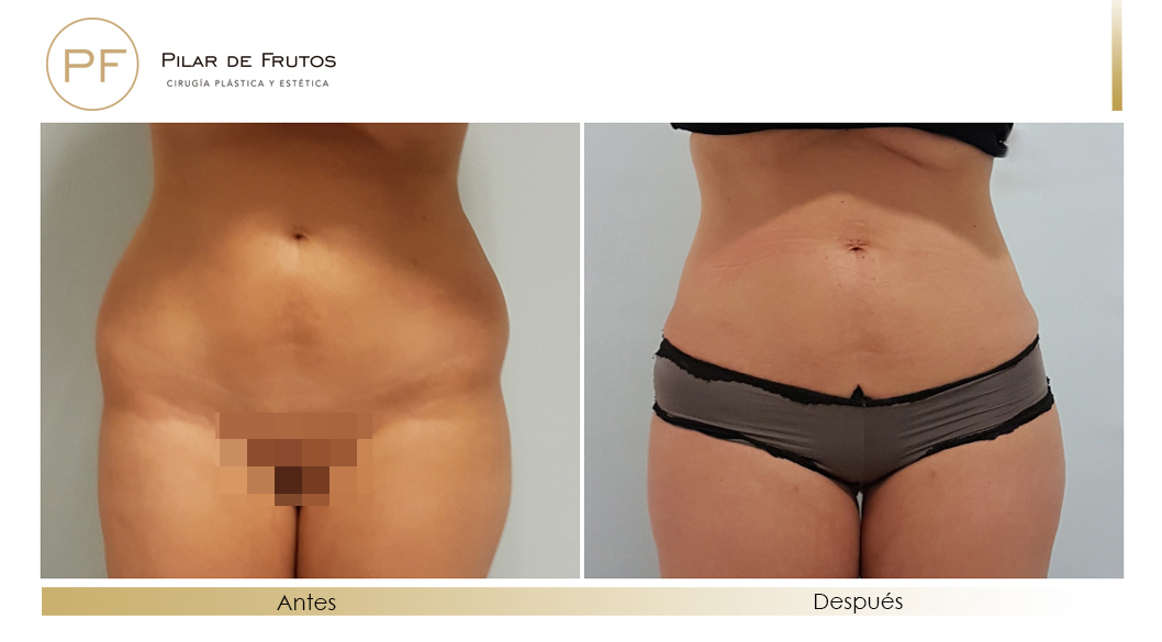 Body Tite Liposucción sin cirugía antes y después Body Tite Liposucción sin cirugía antes y después