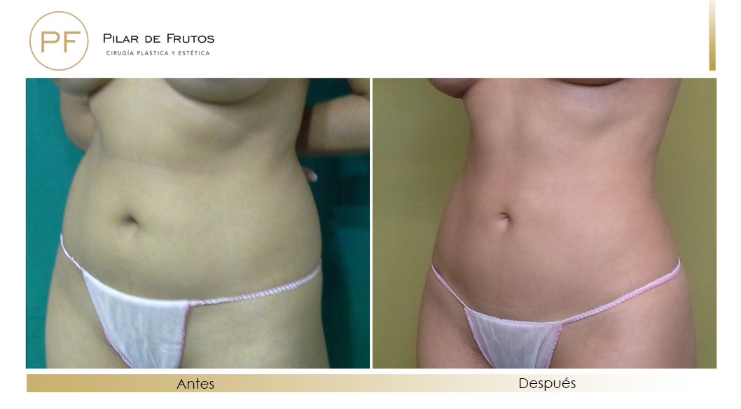 Body Tite Liposucción sin cirugía antes y después Body Tite Liposucción sin cirugía antes y después