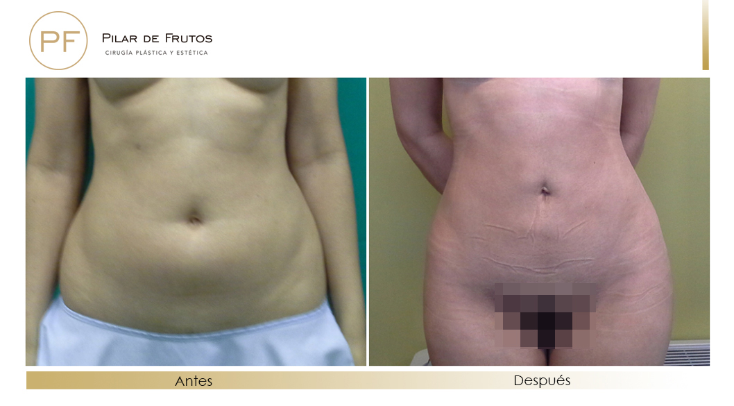 Body Tite Liposucción sin cirugía antes y después Body Tite Liposucción sin cirugía antes y después