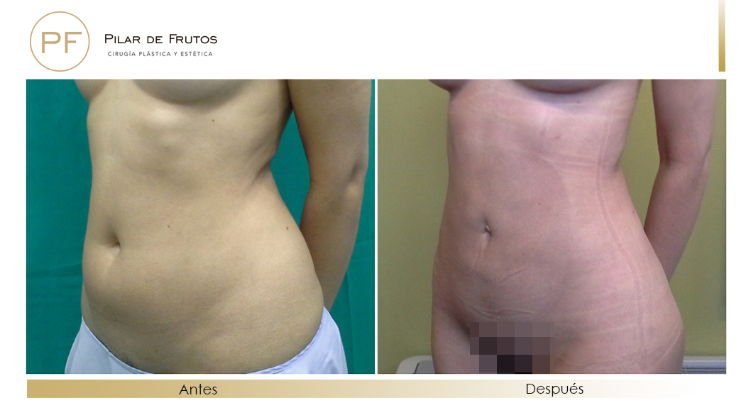 Body Tite Liposucción sin cirugía antes y después Body Tite Liposucción sin cirugía antes y después