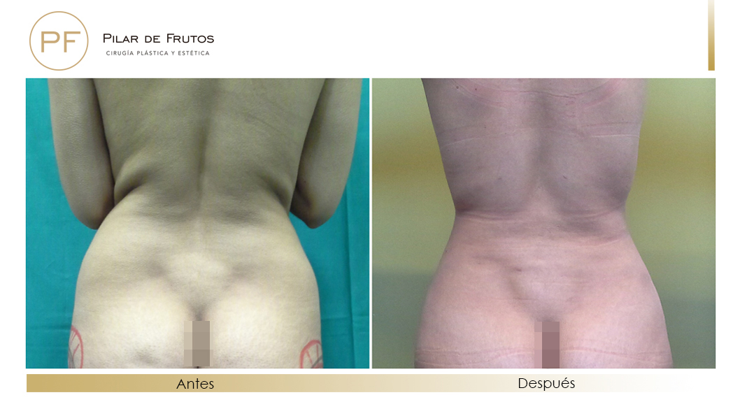 Body Tite Liposucción sin cirugía antes y después Body Tite Liposucción sin cirugía antes y después