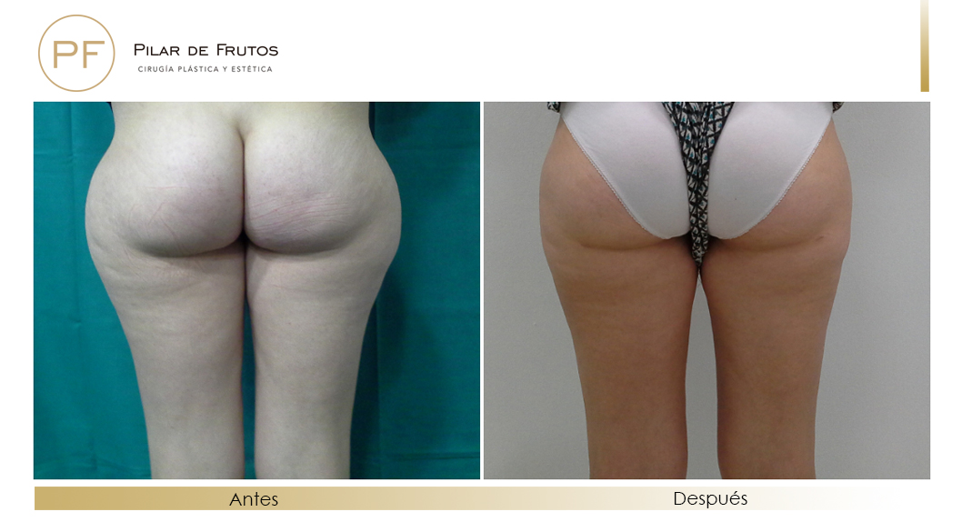 Body Tite Liposucción sin cirugía antes y después Body Tite Liposucción sin cirugía antes y después