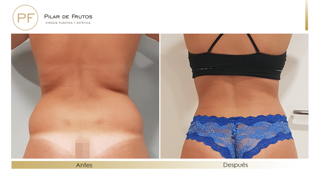 Body Tite Liposucción sin cirugía antes y después Body Tite Liposucción sin cirugía antes y después