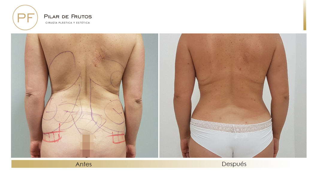 Body Tite Liposucción sin cirugía antes y después Body Tite Liposucción sin cirugía antes y después