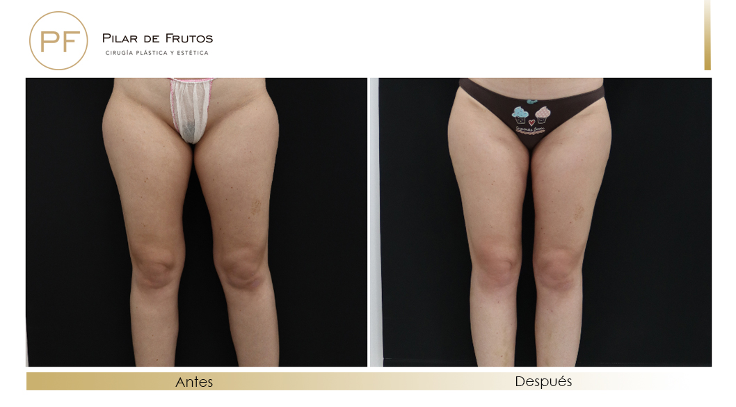 Body Tite Liposucción sin cirugía antes y después Body Tite Liposucción sin cirugía antes y después
