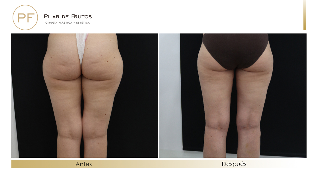 Body Tite Liposucción sin cirugía antes y después Body Tite Liposucción sin cirugía antes y después