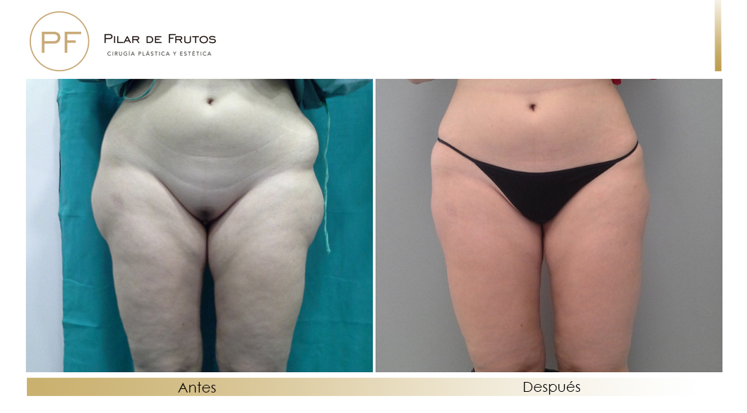 Body Tite Liposucción sin cirugía antes y después Body Tite Liposucción sin cirugía antes y después