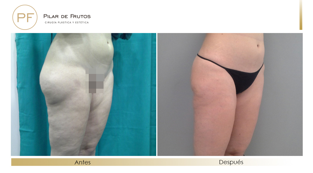 Body Tite Liposucción sin cirugía antes y después Body Tite Liposucción sin cirugía antes y después
