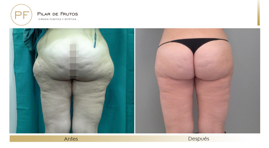 Body Tite Liposucción sin cirugía antes y después Body Tite Liposucción sin cirugía antes y después