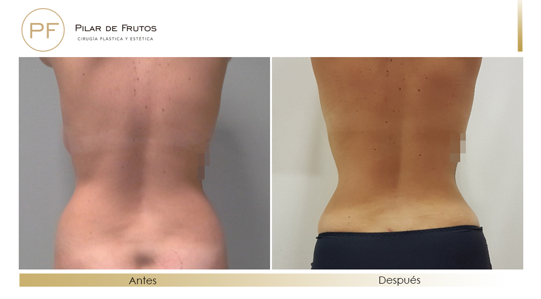 Body Tite Liposucción sin cirugía antes y después Body Tite Liposucción sin cirugía antes y después