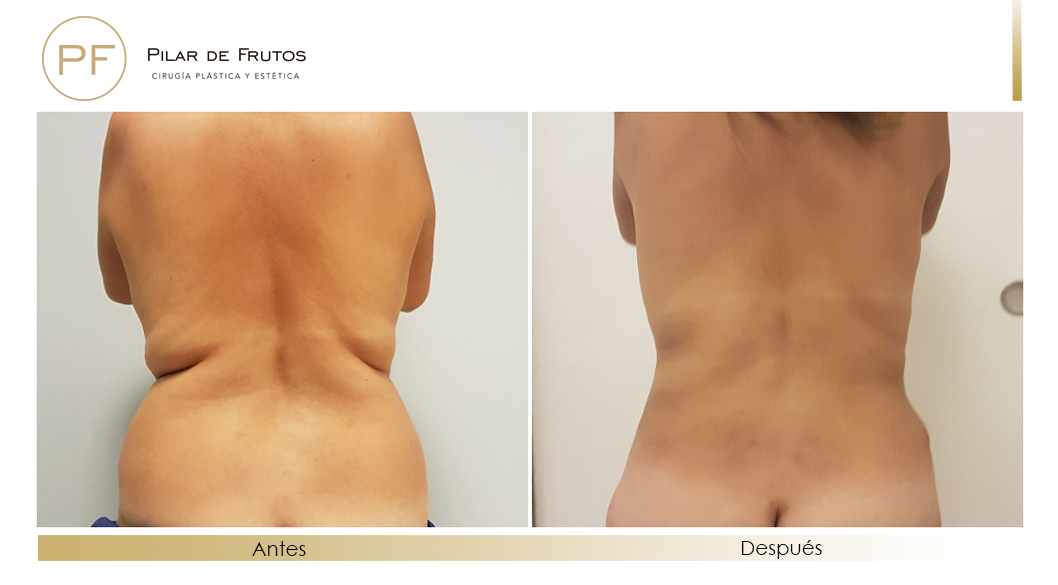 Body Tite Liposucción sin cirugía antes y después Body Tite Liposucción sin cirugía antes y después