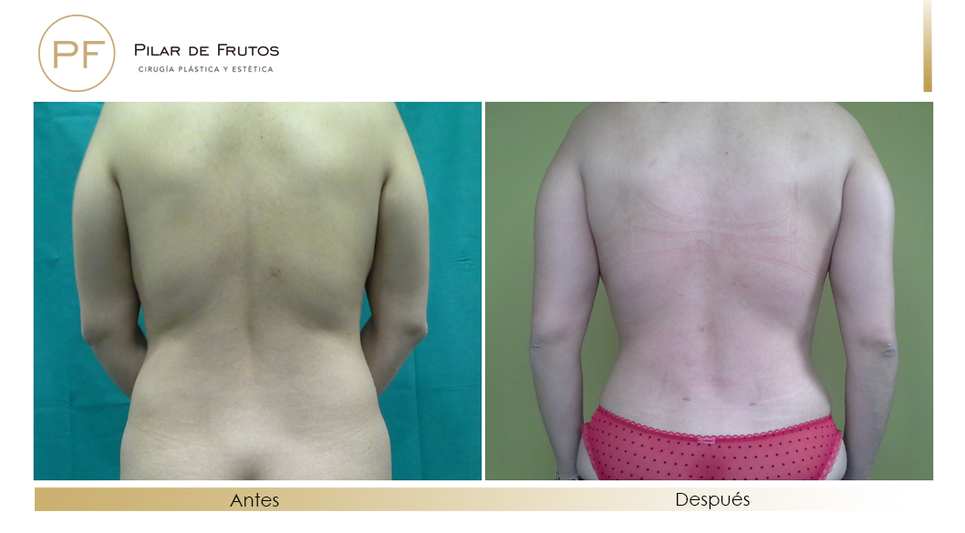 Body Tite Liposucción sin cirugía antes y después Body Tite Liposucción sin cirugía antes y después