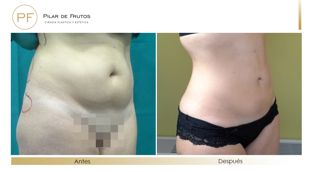 Body Tite Liposucción sin cirugía antes y después Body Tite Liposucción sin cirugía antes y después